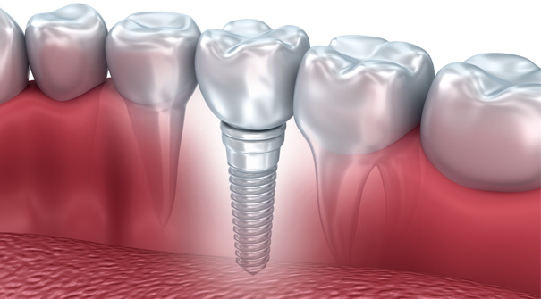 Chirurgie pré-implantaire - Implant dentaire Avesnes sur Helpe